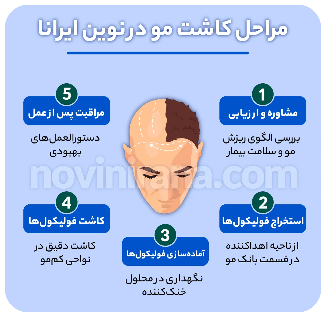 هزینه کاشت مو 